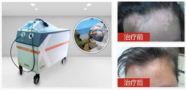 美国进口308准分子激光,儿童、青少年白癜风患者优选