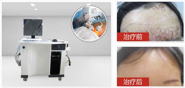 第三代黑色素细胞种植,稳定期、大面积白癜风患者优选